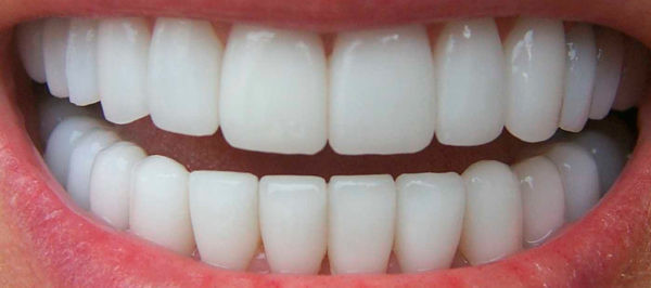 Види коронок для зубів, яку вибрати - зображення